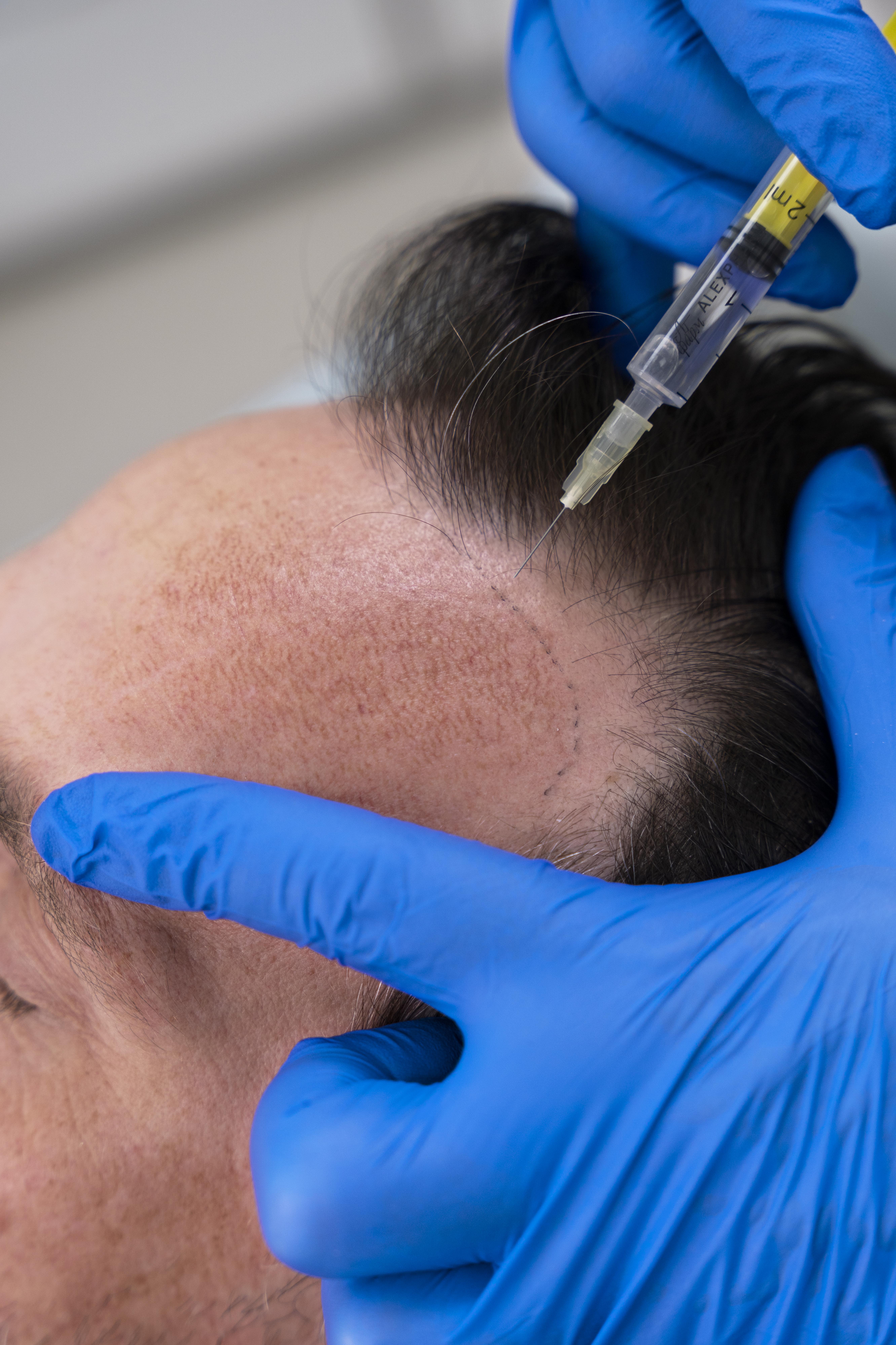 PRP (Hair)