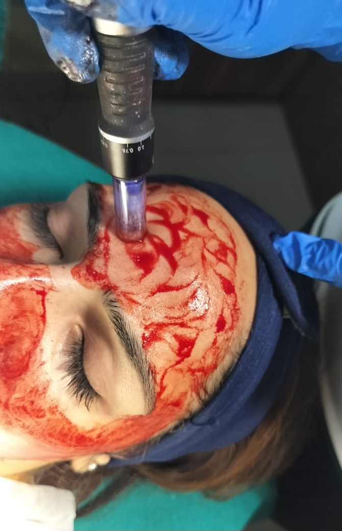 Vampire Facial