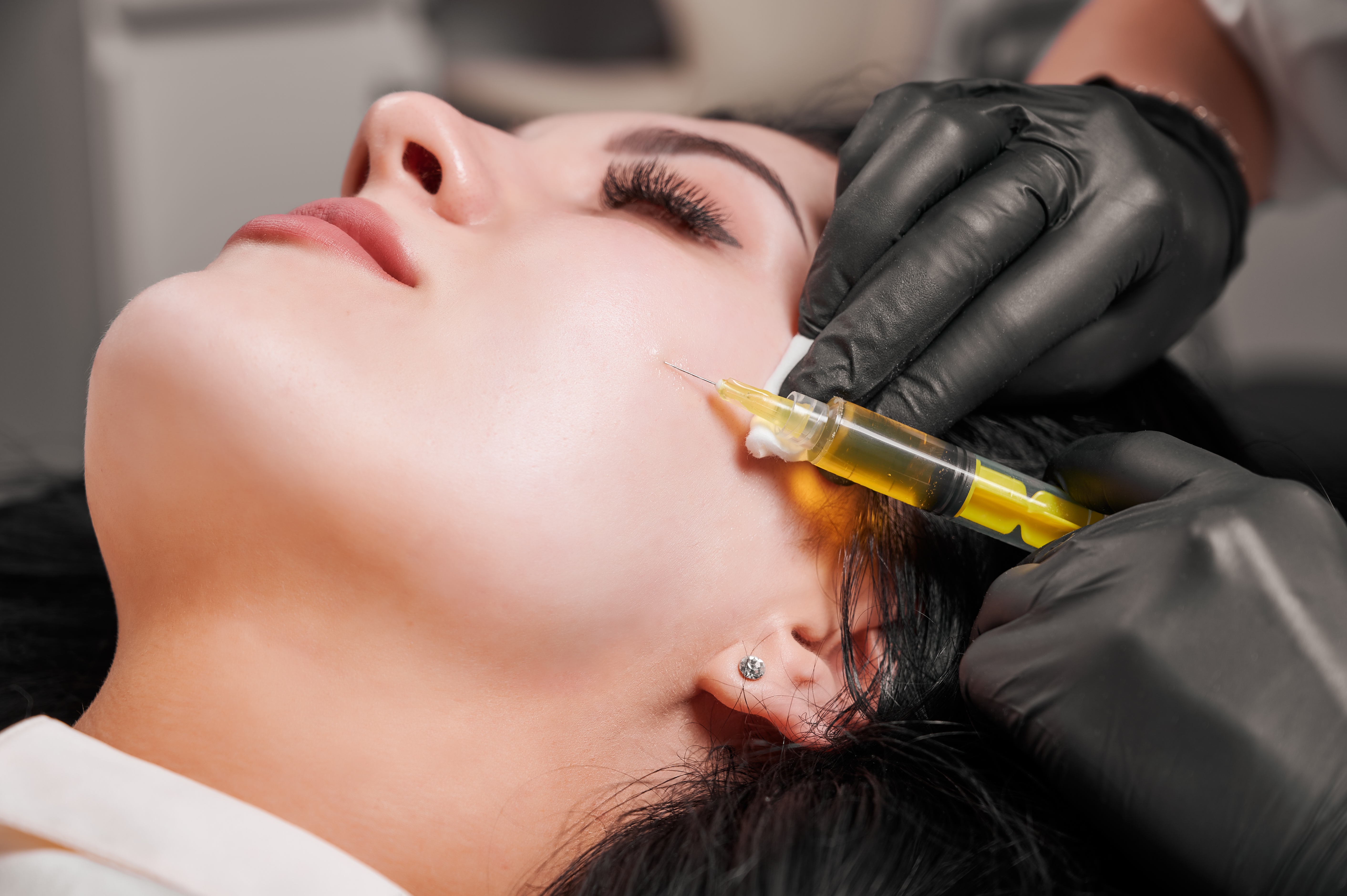 Vampire Facial (PRP)